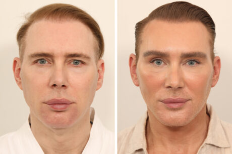 Blepharoplasty case #5574