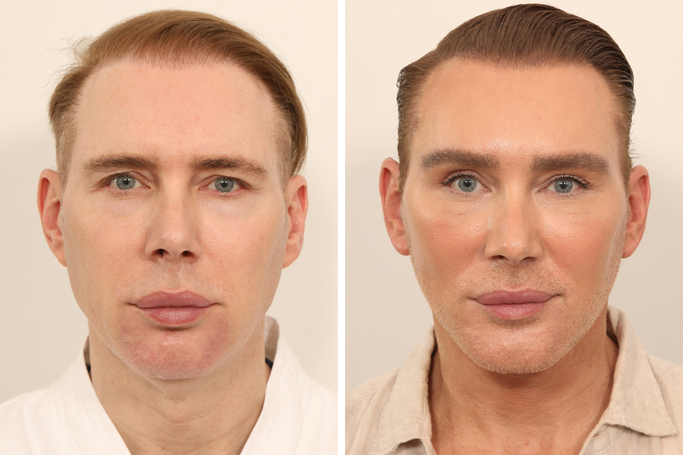 Blepharoplasty case #5574