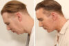 Blepharoplasty case #5574 slider thumbnail