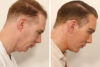 Blepharoplasty case #5574 slider thumbnail