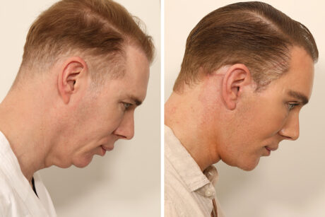 Blepharoplasty case #5574