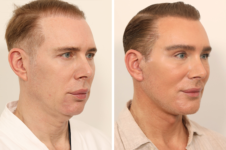 Blepharoplasty case #5574