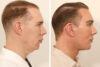 Blepharoplasty case #5574 slider thumbnail