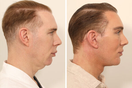 Blepharoplasty case #5574