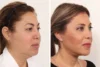 Blepharoplasty case #5634 slider thumbnail