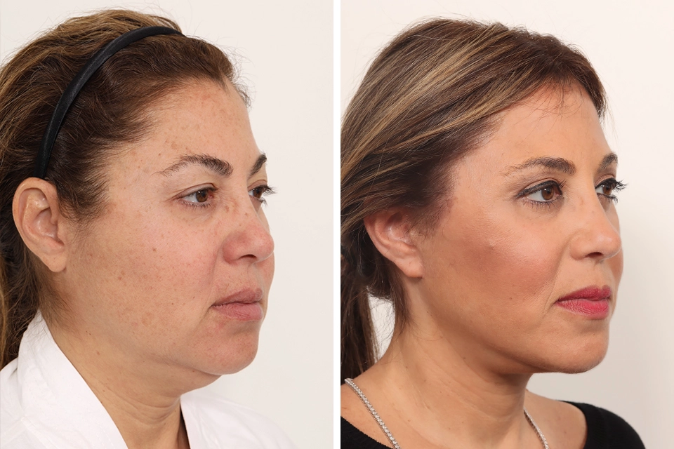 Blepharoplasty case #5634