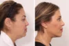Blepharoplasty case #5634 slider thumbnail