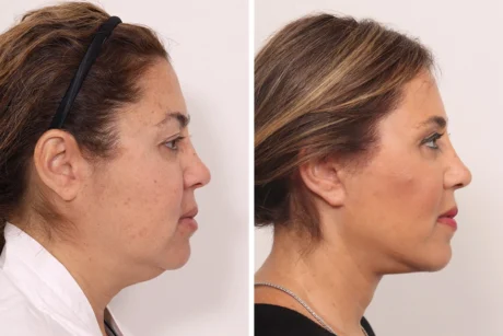 Blepharoplasty case #5634