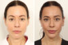 Facelift case #5762 slider thumbnail