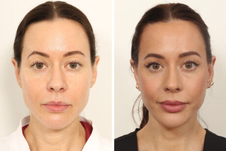 Facelift case #5762