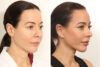 Facelift case #5762 slider thumbnail