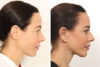 Facelift case #5762 slider thumbnail
