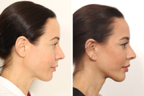 Facelift case #5762