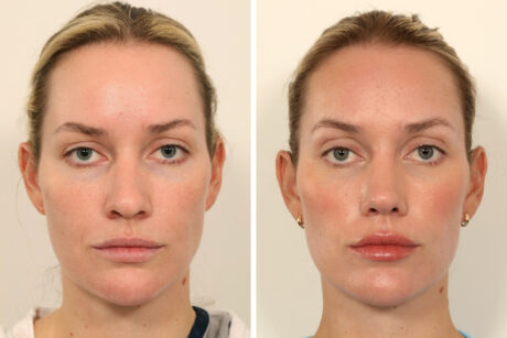 Rhinoplasty case #6101