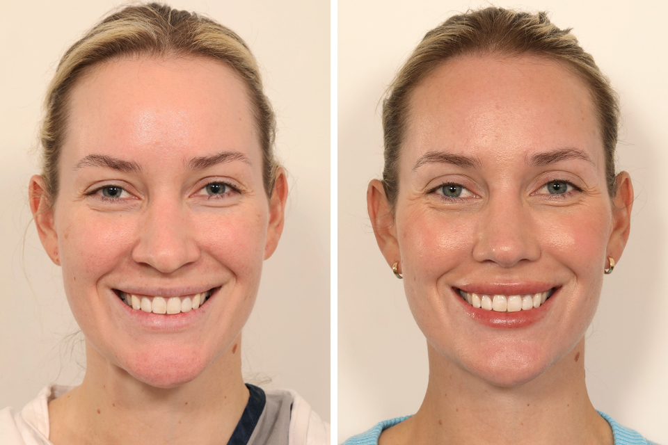 Rhinoplasty case #6101