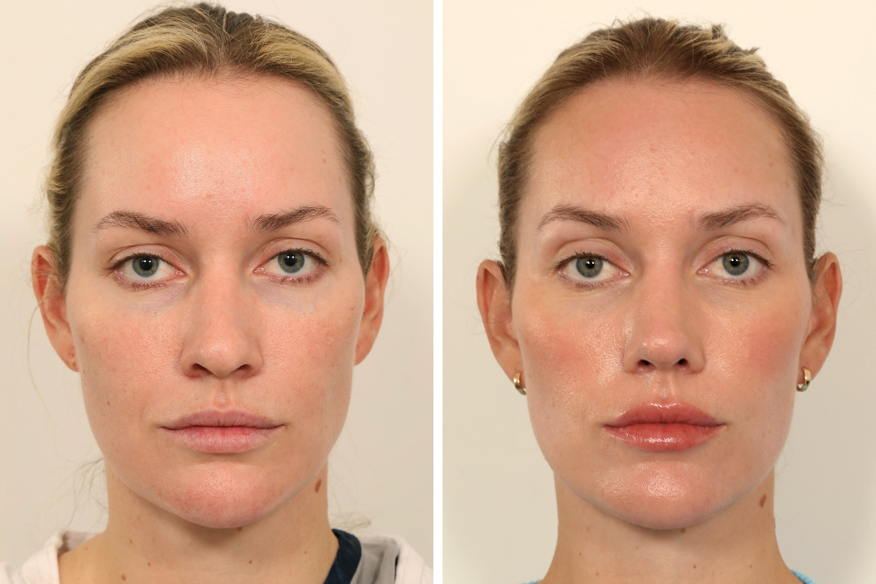 Rhinoplasty case #6101