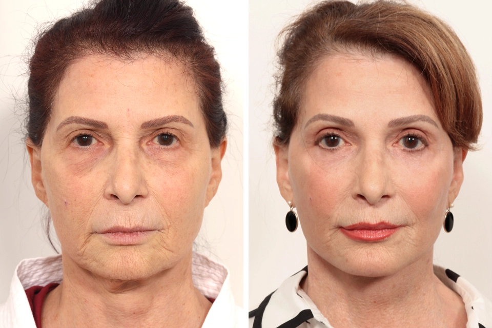 Brow Lift case #6148