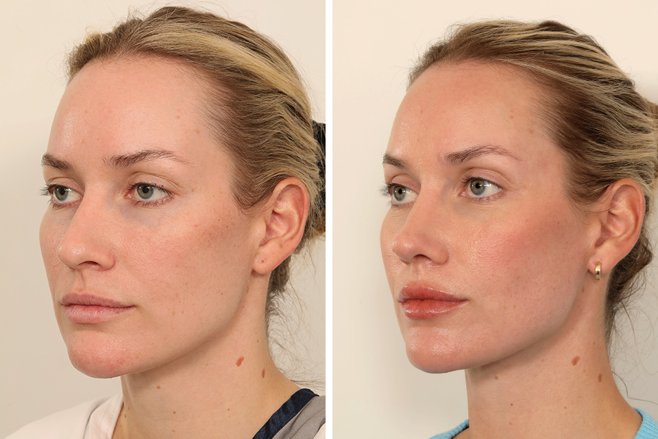 Rhinoplasty case #6101