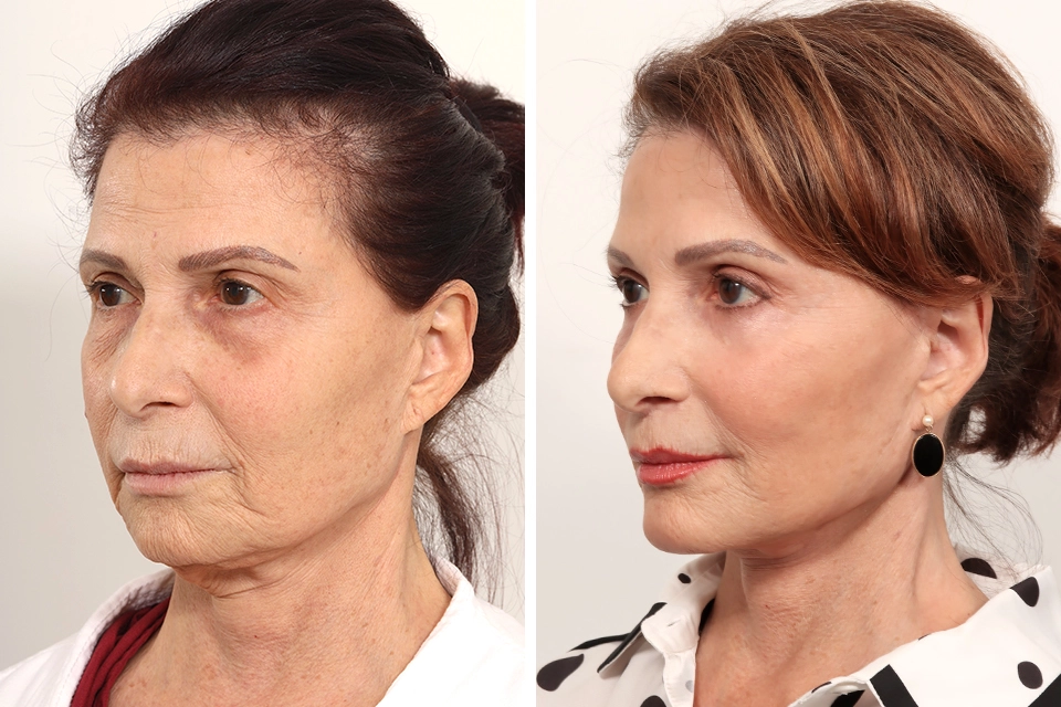 Brow Lift case #6148