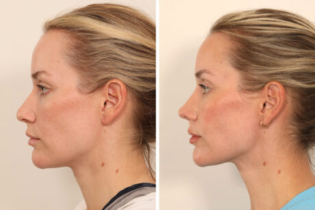 Rhinoplasty case #6101