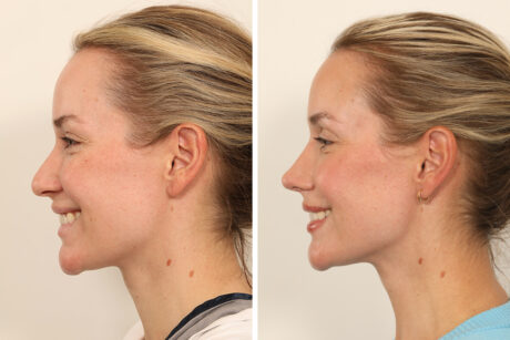 Rhinoplasty case #6101