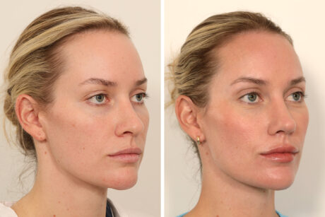 Rhinoplasty case #6101