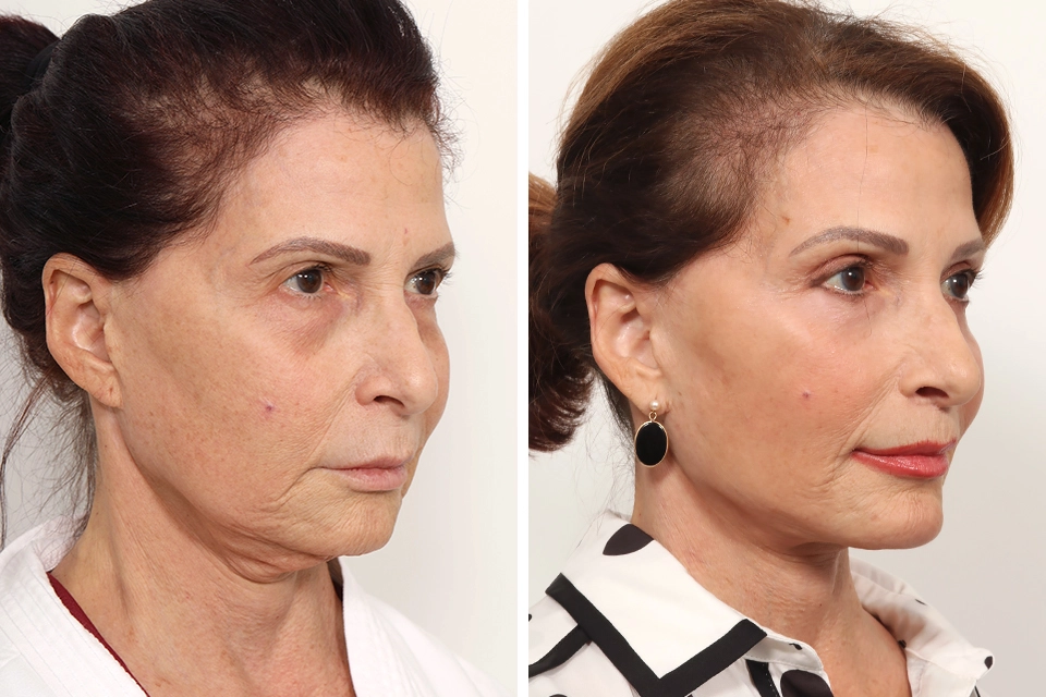 Brow Lift case #6148