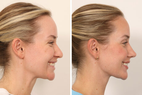 Rhinoplasty case #6101