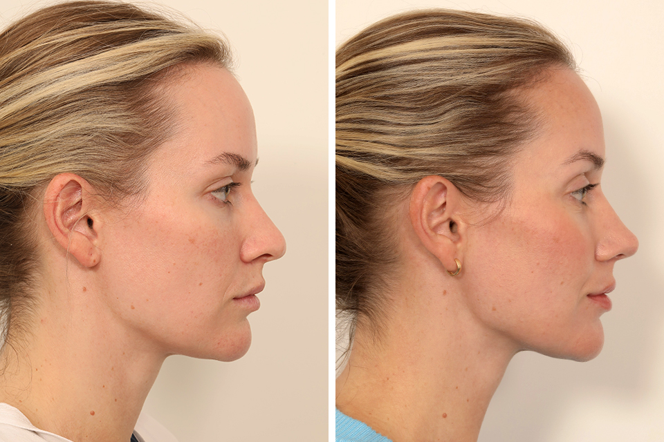 Rhinoplasty case #6101