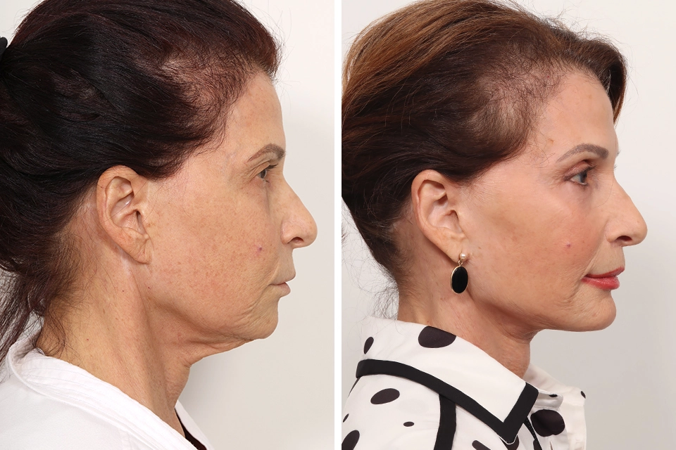 Brow Lift case #6148