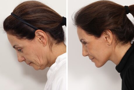 Facelift case #6475