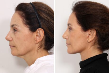Facelift case #6475