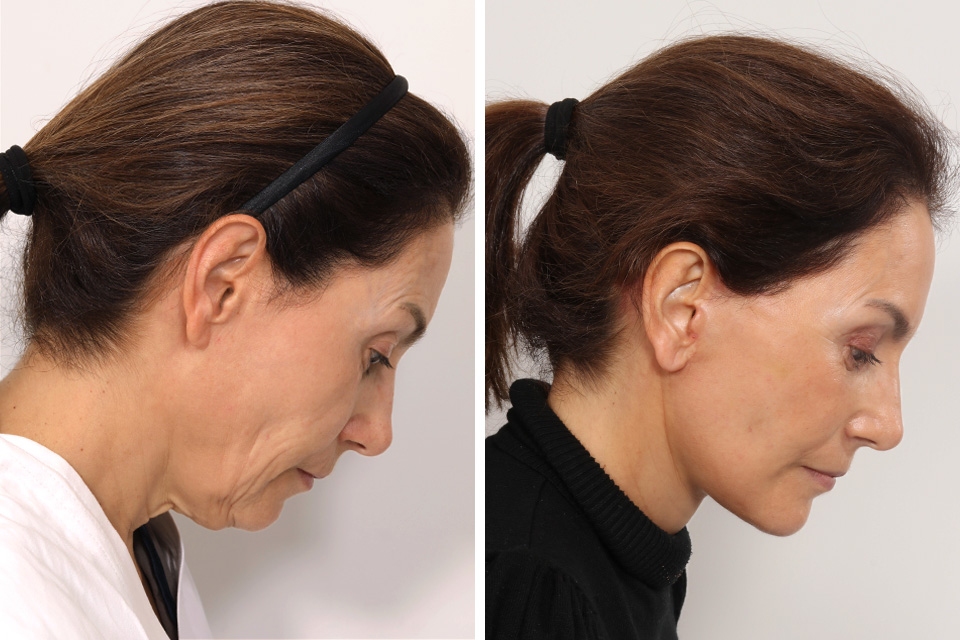 Facelift case #6475