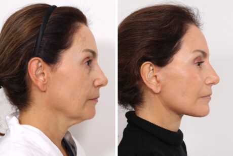 Facelift case #6475