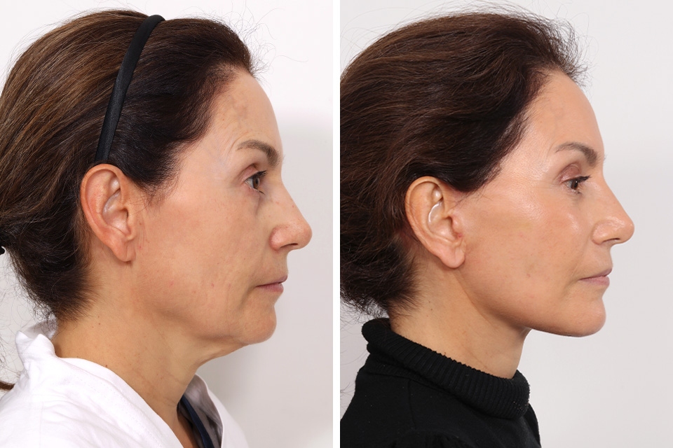 Facelift case #6475
