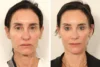 Rhinoplasty case #7694 slider thumbnail