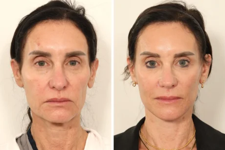 Rhinoplasty case #7694