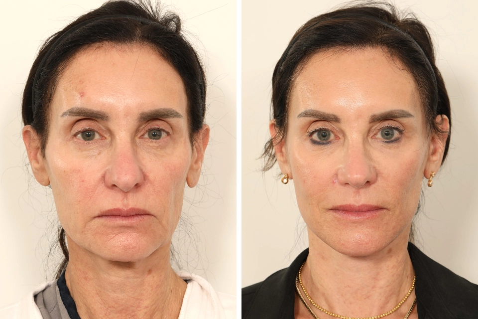 Facelift case #7688