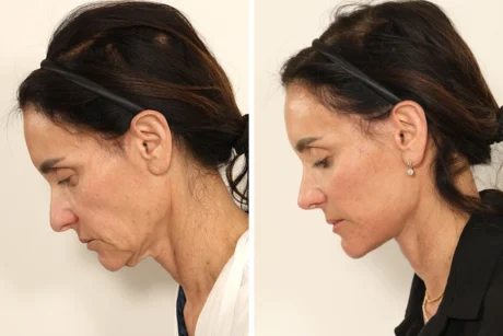 Rhinoplasty case #7694
