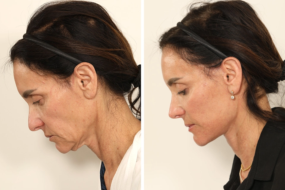 Facelift case #7688