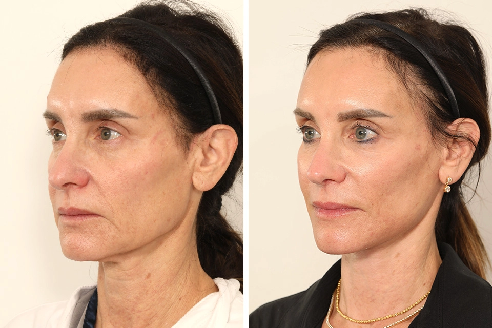 Facelift case #7688