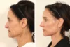 Rhinoplasty case #7694 slider thumbnail
