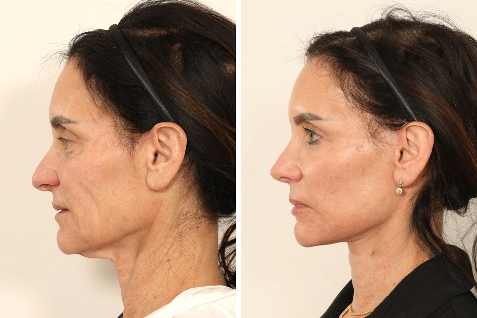 Facelift case #7688