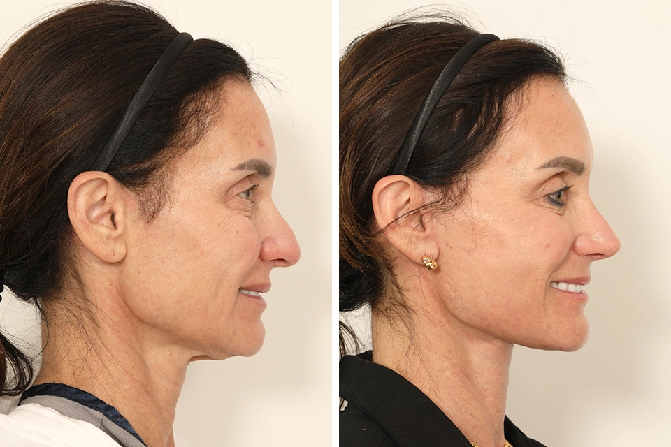 Facelift case #7688