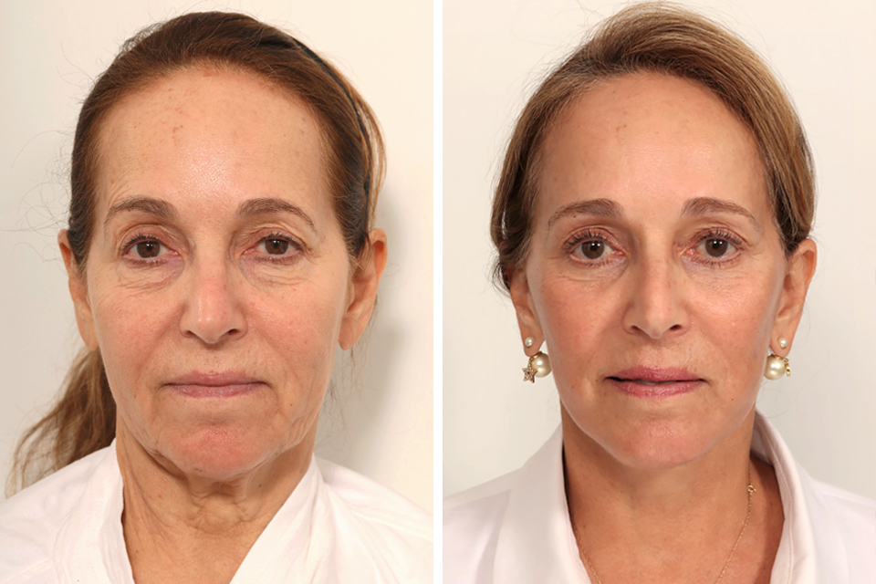 Blepharoplasty case #7923