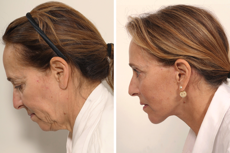 Blepharoplasty case #7923