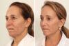 Brow Lift case #7925 slider thumbnail
