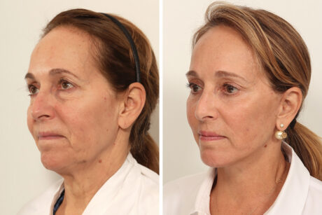 Brow Lift case #7925