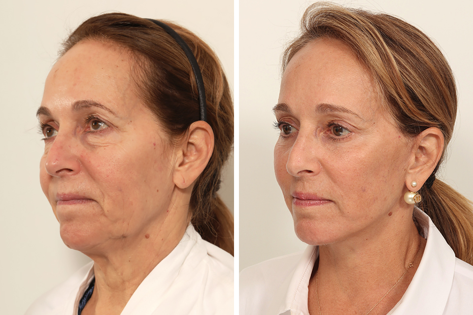 Blepharoplasty case #7923