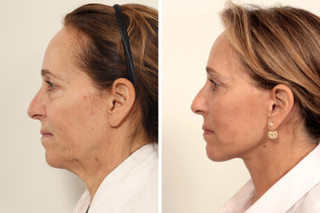 Brow Lift case #7925